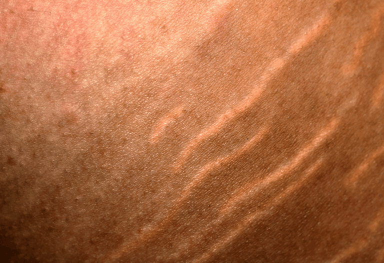 vergetures adolescence